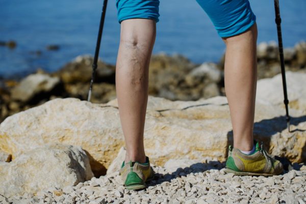 Important Facts About Varicose Veins That You Should Know