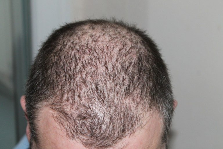 Hair Loss Causes and Treatments